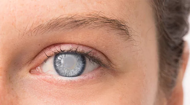 Picture Meningkatnya Kasus Glaukoma di Usia Muda: Sebuah Perhatian Serius