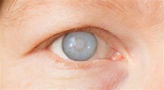 Picture Inovasi Terbaru dalam Pengobatan Katarak dan Penyakit Retina